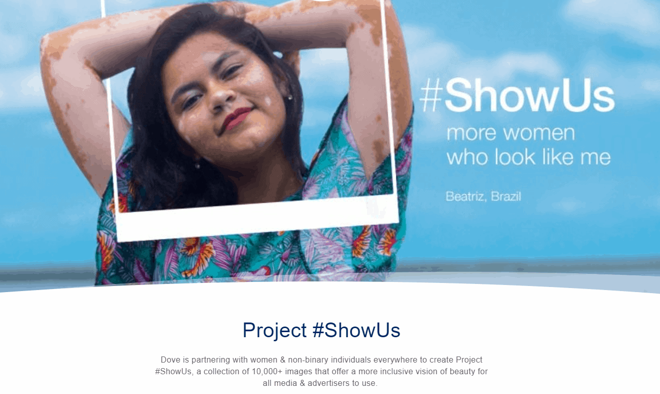 Femeie cu vitiligo pozând cu brațele în spatele capului