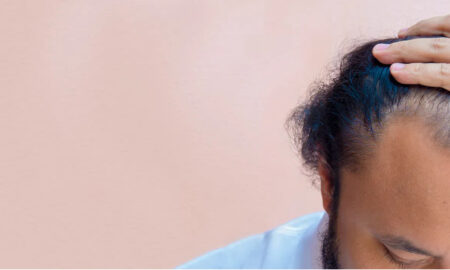 ทำไมปัญหาผมร่วงจึงเป็นเรื่องใหญ่สำหรับผู้ชาย? และมีประเภทใดบ้าง