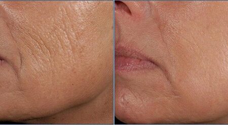 您需要知道的 10 個皺紋治療技巧