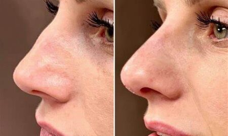 Ameliyatsız Burun Estetiğinin 8 Faydası Nedir?