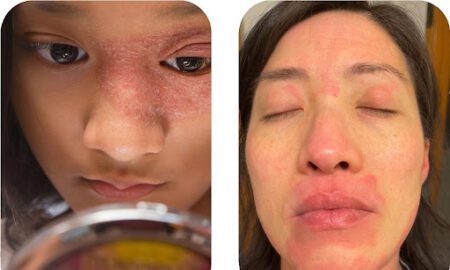 Dermatite seborroica contro eczema: qual è la differenza